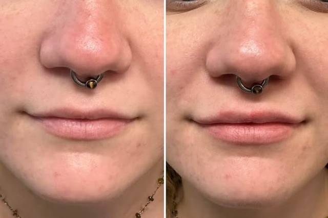 Before and After