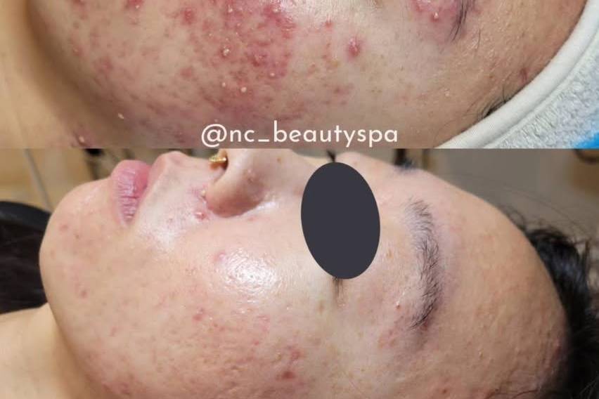 Fewer breakouts, less inflamma