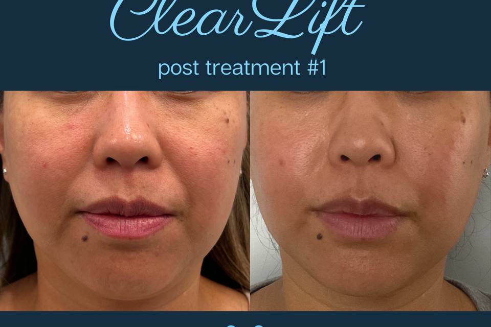 Clear Lift 1 month post