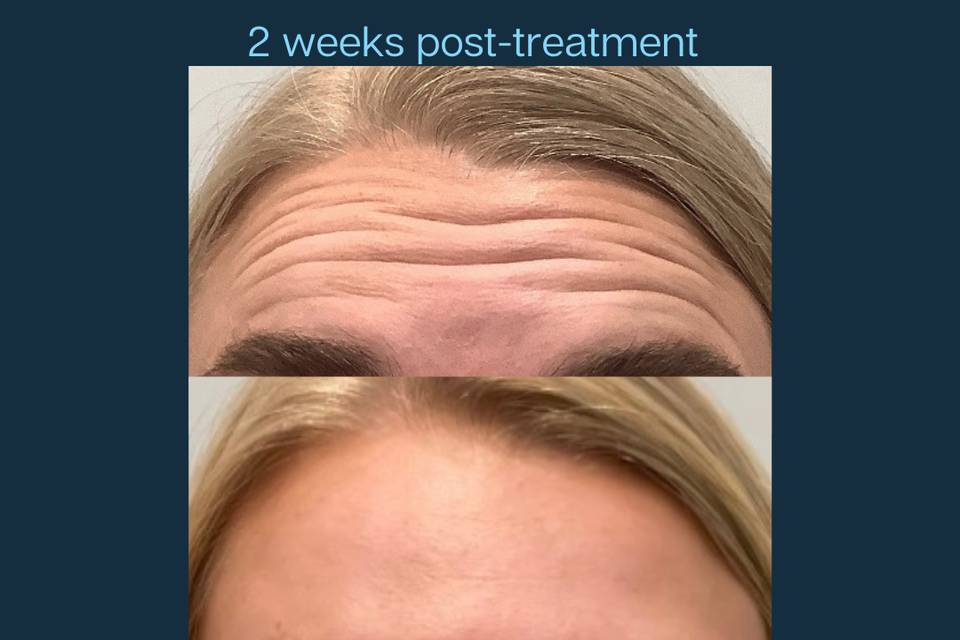 2 weeks post-treatment