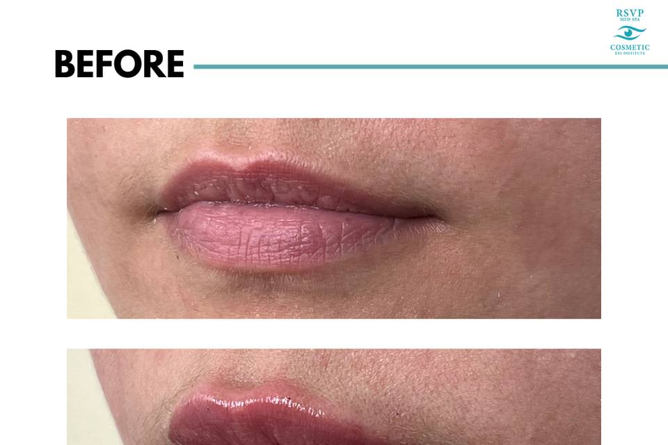 Lip Filler