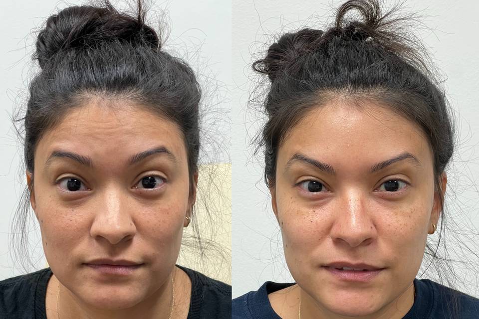 Botox