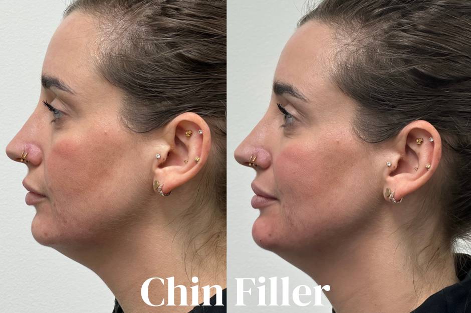 Chin Filler