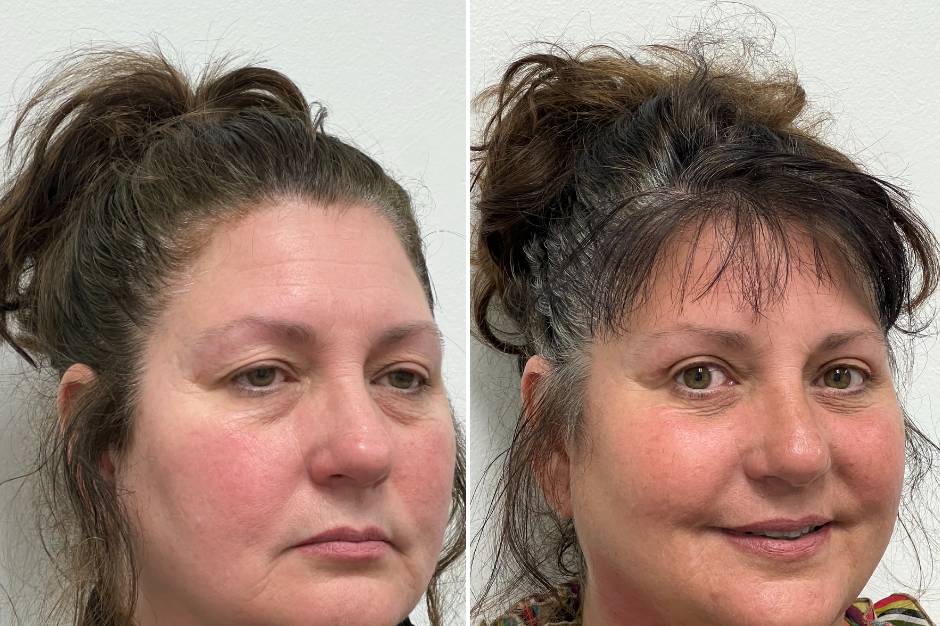 Upper/Lower Bleph, Ptosis Repa