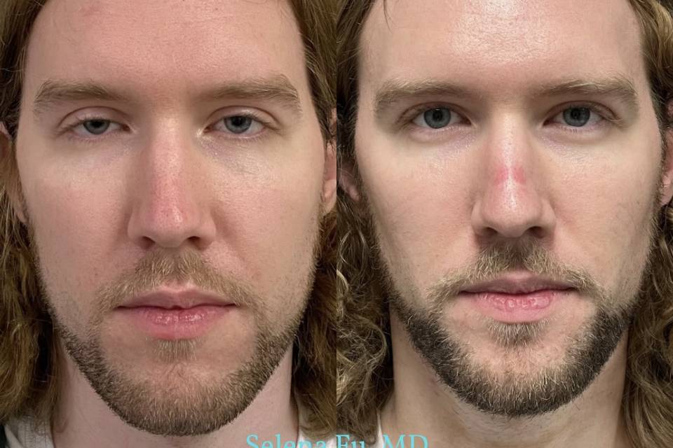 Ptosis Repair