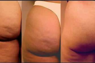 Smooth Your Cellulite
Reduce Circumference
Tighten Skin
The staff at LaserCare Cosmetic  Centers  commonly see patients with a variety of concerns, ranging from  cellulite and unwanted ‘figure flaws’ such as saddlebags, muffin tops, and bra roll fat.
Velashape III™ is the only non-invasive treatment that can help contour and shape your body, while providing smoother, tighter skin.
LaserCare Cosmetic centers is one of only a handful practices offering the revolutionary Velashape III™!