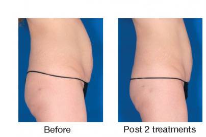 Smooth Your Cellulite
Reduce Circumference
Tighten Skin
The staff at LaserCare Cosmetic  Centers  commonly see patients with a variety of concerns, ranging from  cellulite and unwanted ‘figure flaws’ such as saddlebags, muffin tops, and bra roll fat.
Velashape III™ is the only non-invasive treatment that can help contour and shape your body, while providing smoother, tighter skin.
LaserCare Cosmetic centers is one of only a handful practices offering the revolutionary Velashape III™!