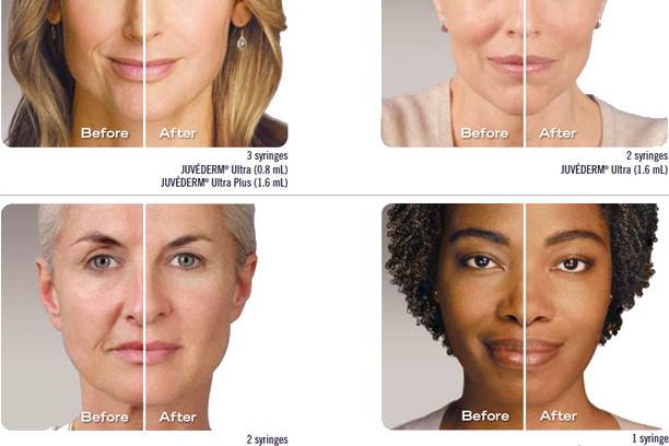 As we age, our skin changes. Over time, the natural volume of youthful skin begins to diminish as wrinkles and folds form. You don’t have to just sit back and let it happen!
Injectible fillers, like Juvéderm and Restylane, are used to restore volume and fullness to the skin, and smooth away facial wrinkles and folds. Facial Fillers produce very pleasing enhancements, most commonly for the lower face: “laugh lines,” “smile lines” or “parentheses”, or “marionette lines”, cheeks, chin and “tear trough” (fill the sunken in area under the eyes. Lip injections are popular to restore lip volume lost over time or to enhance lips that have always been thin or uneven. The result is a smooth, natural look and feel.