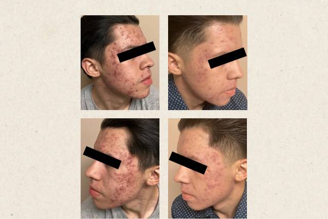 Before/After 5 Acne Treatments