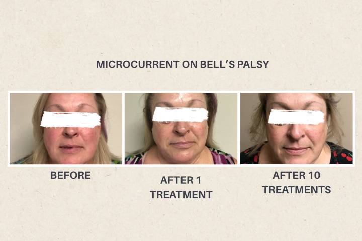 Microcurrent on Bell's Palsy