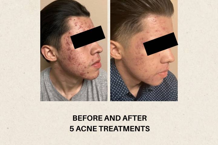 Before/After 5 Acne Treatments