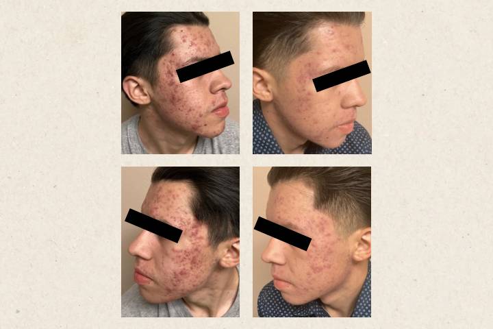 Before/After 5 Acne Treatments