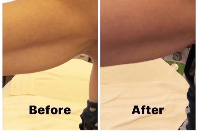 Microcurrent/Radiofrequency