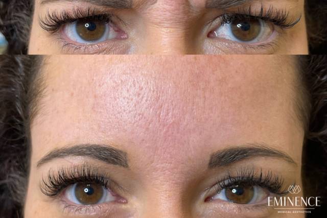 Botox: Glabella