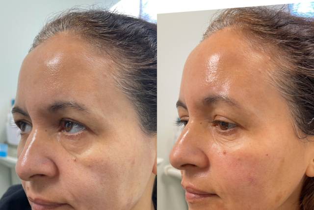 Filler: Cheeks