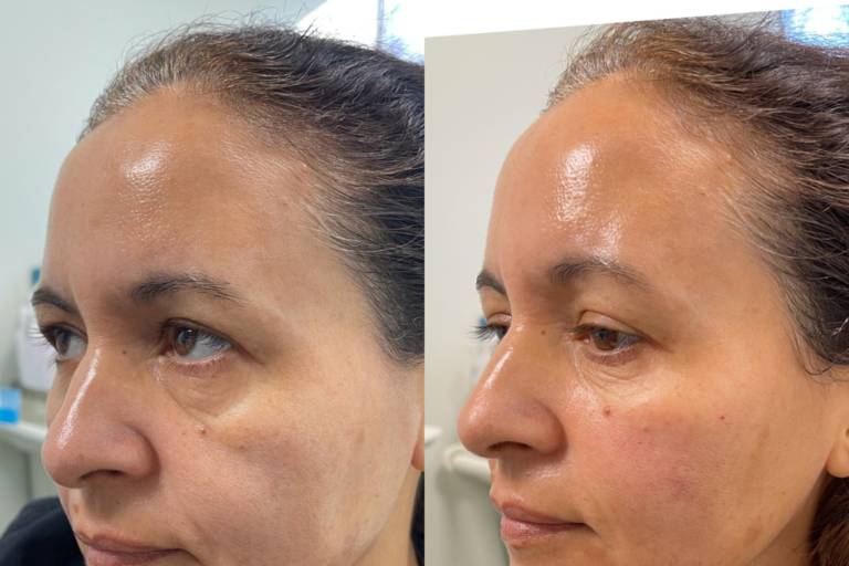 Filler: Cheeks