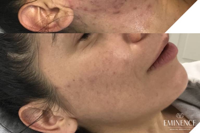 Laser Genesis + Microneedling