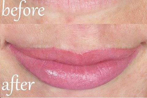 Lip transformation