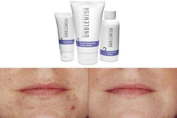 Before and after with the Unblemish line