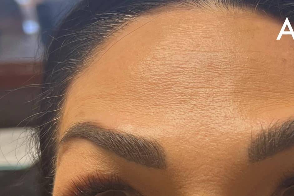 After Botox for Forehead Lines