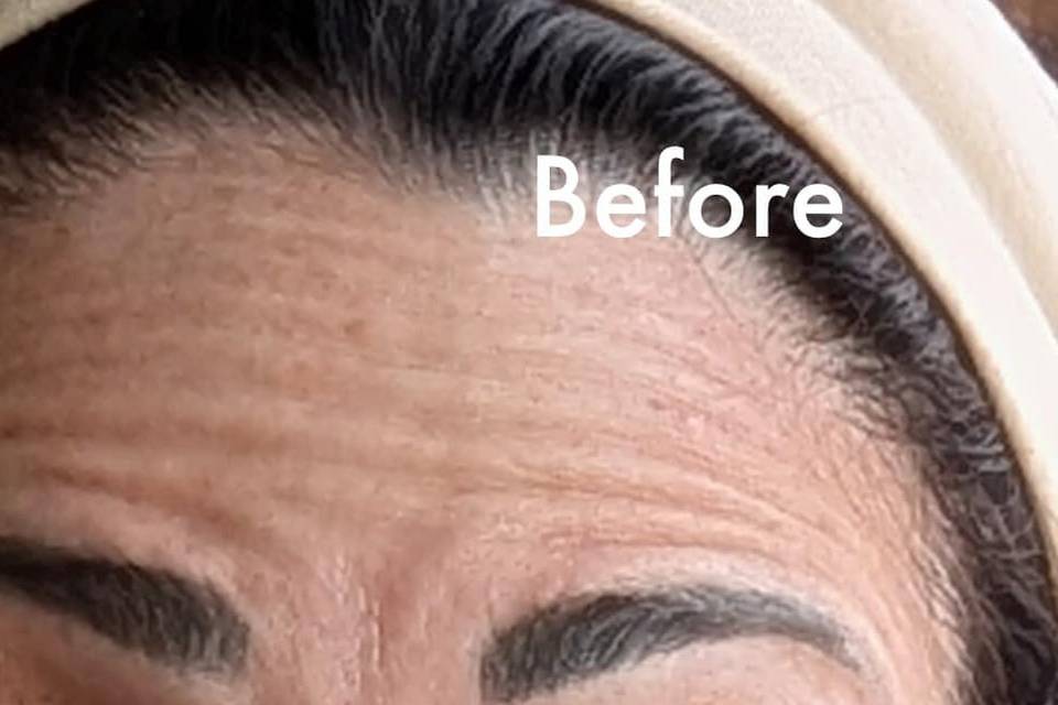 Before Botox for Forehead Line