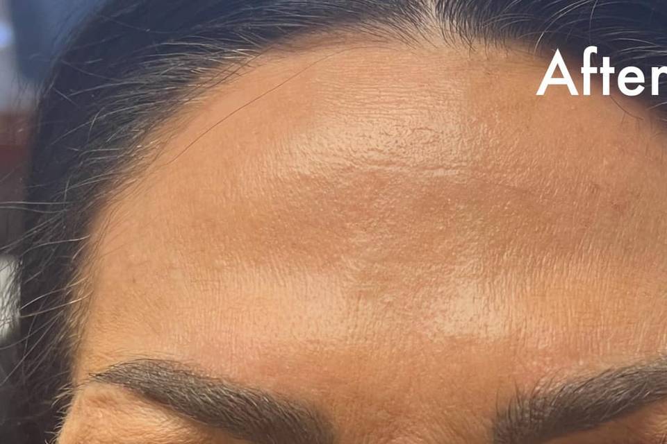 After Botox for Frown Lines