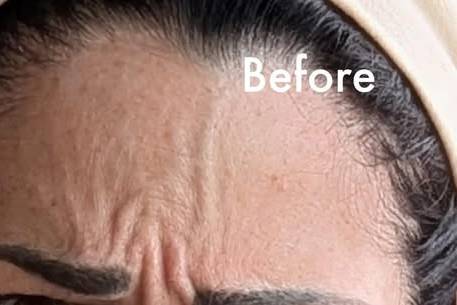Before Botox for Frown Lines