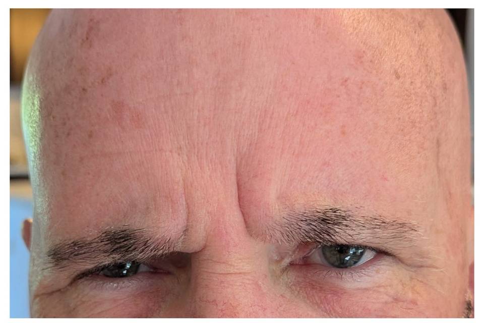 Before and after Botox for Fro