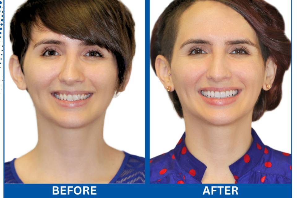 Before and After