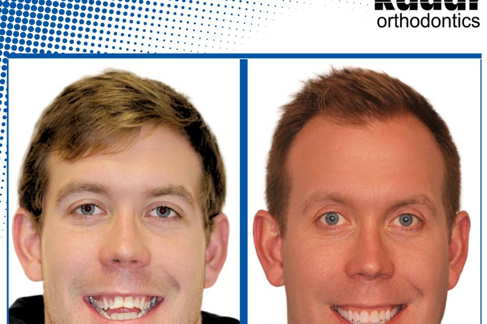 Before and After