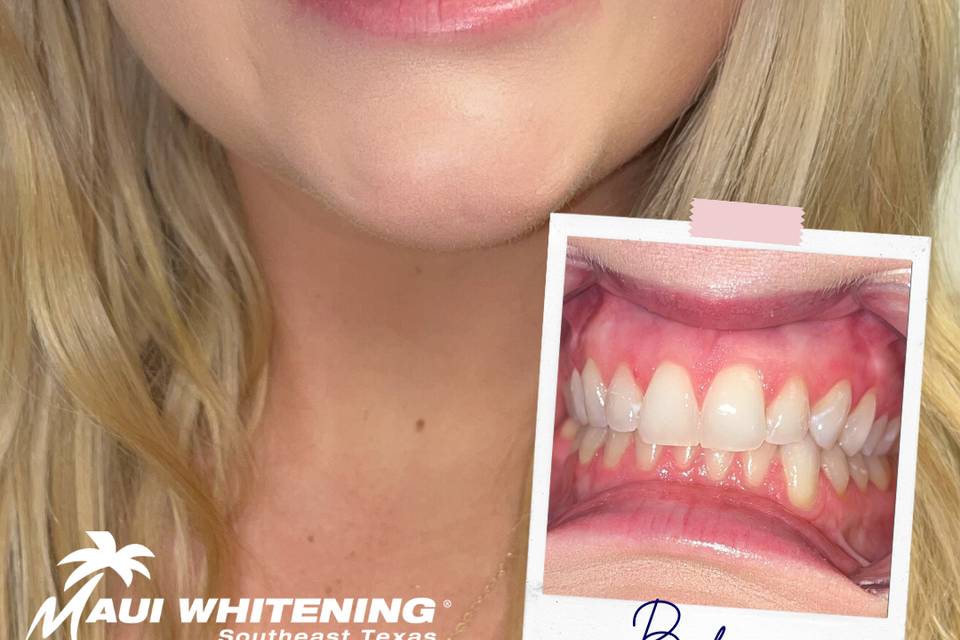 Maui Whitening SETX