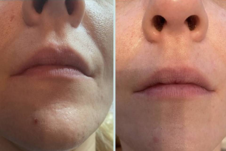 Face/jaw sculpting