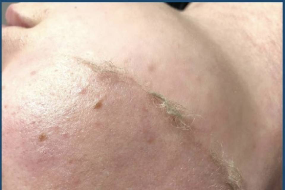 Dermaplaning