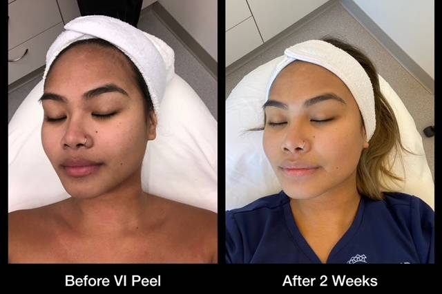 VI Peel Before and After