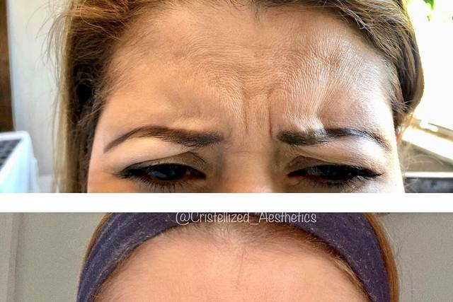 Botox before and after