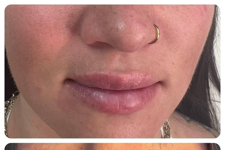 Lip filler before & after
