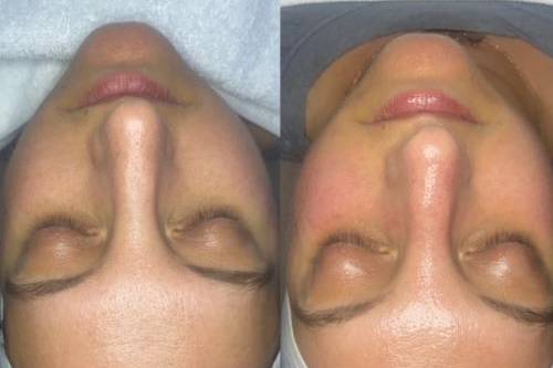 Before/After Hydro facial