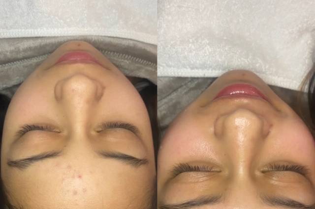 Before/After Dermaplaning