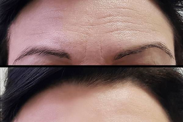 Botox
