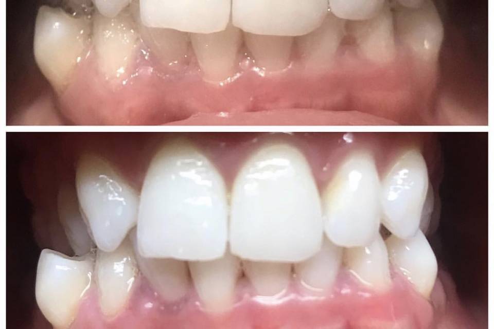 Custom tray teeth whitening