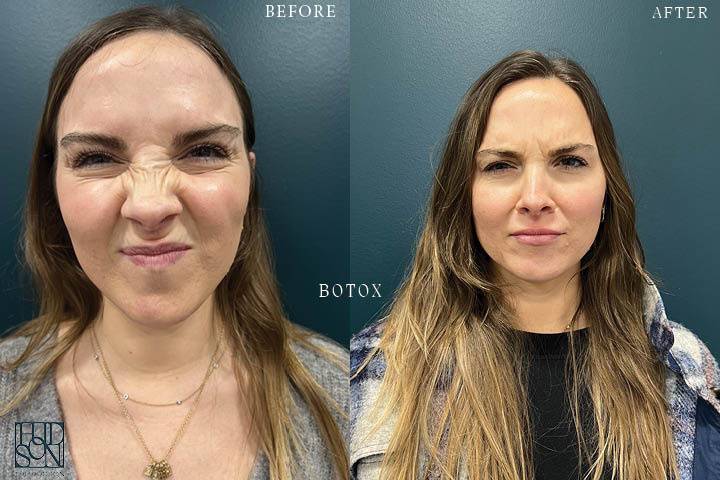 Botox Before & After