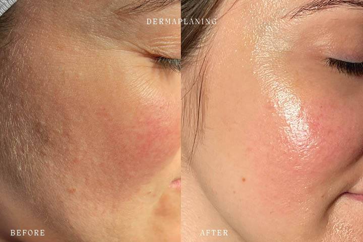 Dermaplaning Before and After