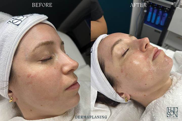 Dermaplaning Before & After