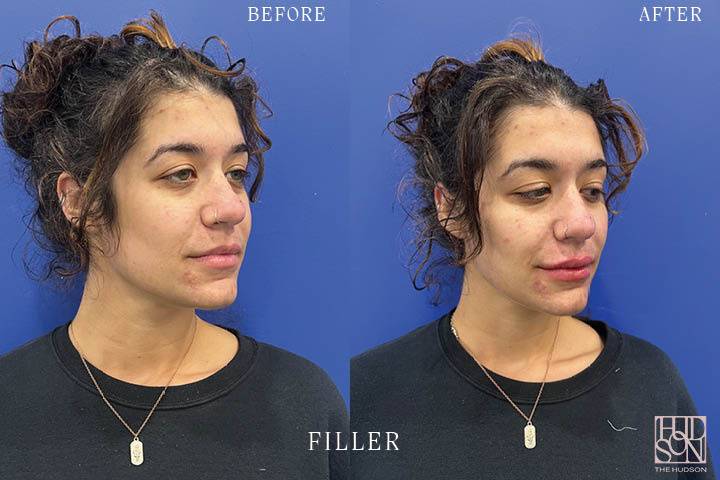 Filler Before & After