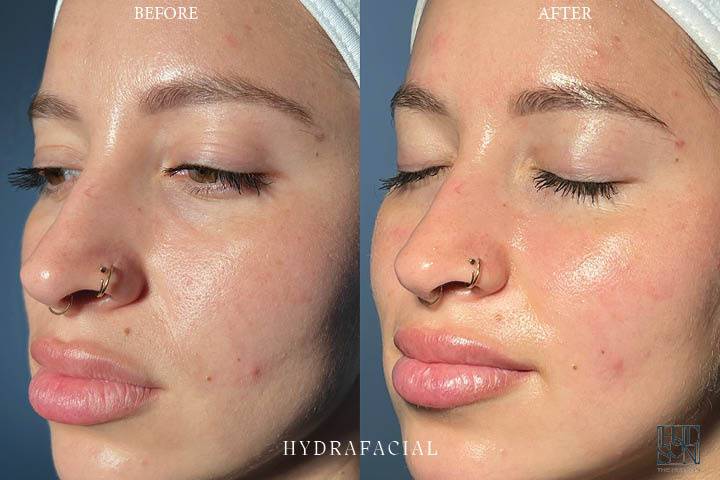 HydraFacial Before & After