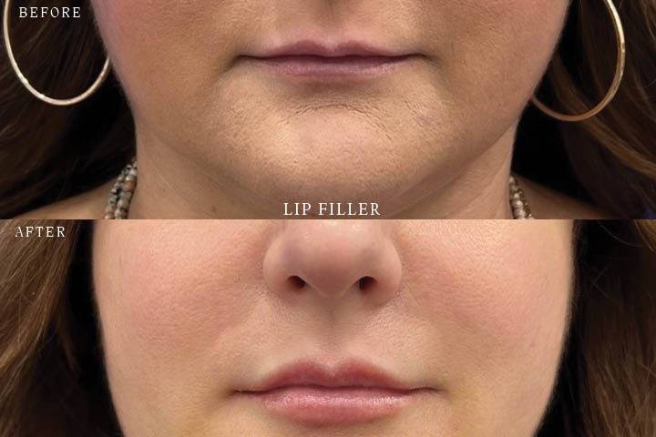 Lip Filler Before & After