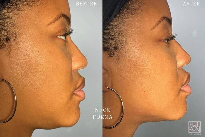 Neck Forma Before & After