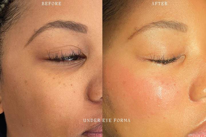 Under Eye Forma Before & After