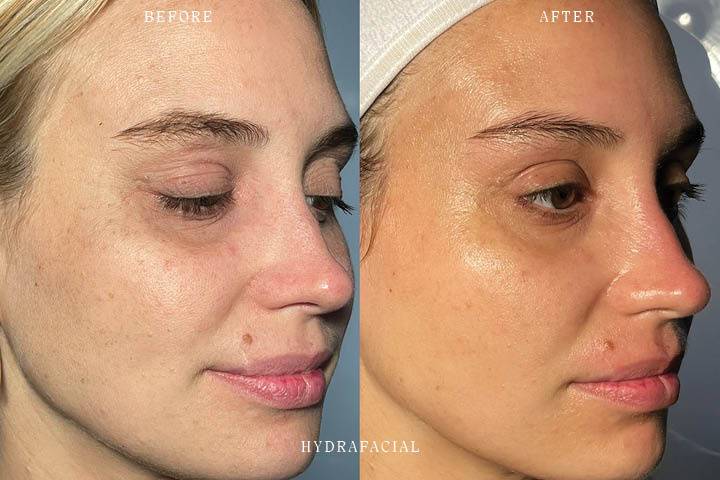 HydraFacial Before & After