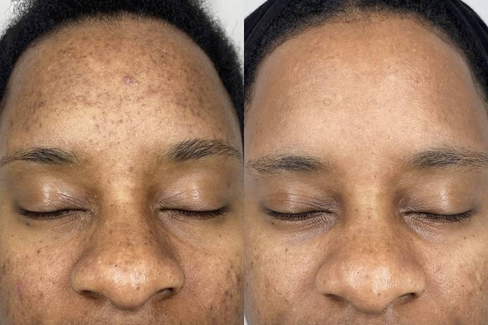 Before/ After peel